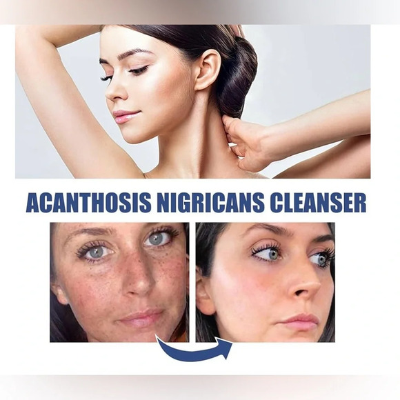 NWT Acne and Spots Cleansing Lotion Relief 50ml for Dry Skin Facial Cleanser - Picture 9 of 11